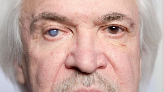 Augen auf vor der Operation des Grauen Stars