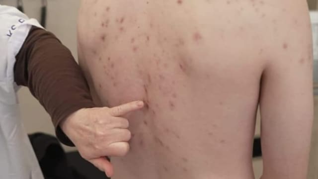 Akne: Was wirklich hilft und was nicht